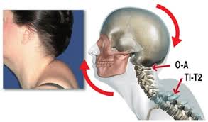 Famous physical therapists bob schrupp and brad heineck present how to get rid of neck hump using a sock. Brenda S Dreaded Dowager S Hump Erik Dalton Blog