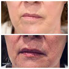 A cosmetic dermatologist may be able to reduce or remove fine lines, small scars, blemishes, freckles, sun damaged skin and precancerous cells. Before And After Aesthetic Solutions