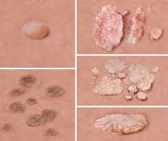 Image result for genital warts