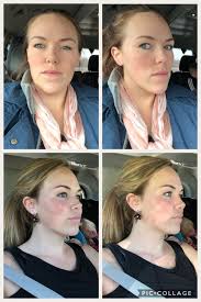 Pin On Jaw Surgery