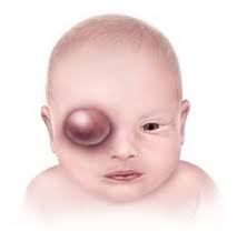 BIRTH DEFECTS SURVEILLANCE