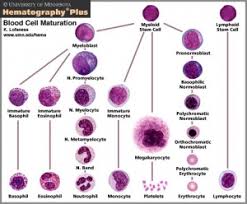 Acute lymphocytic leukemia (all) progresses rapidly, replacing healthy cells that produce functional lymphocytes with leukemia cells that can't mature properly. Leukemia Wikem