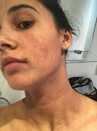 Naomi Scott Opens Up About Having Eczema — Heres What to Do If You Have It  Too | Teen Vogue