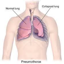 A pneumothorax can be caused by: Pneumothorax Wikipedia