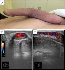 Image result for Priapism