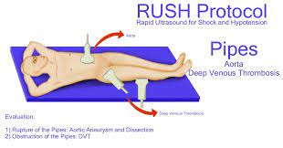 Maybe you would like to learn more about one of these? Rapid Ultrasound For Shock And Hypotension Rush Protocol Us Imaging Illustrations International Emergency Medicine Education Project