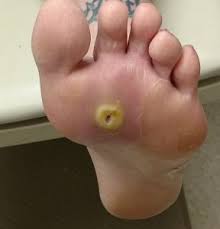 Image result for diabetic toes