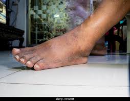Image result for toe black diabetes