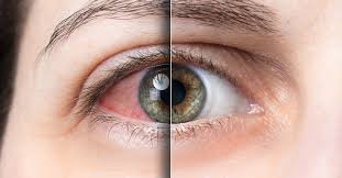 I seem more sensitive to bright lights but not too bad. Dry Eye A Leading Cause Of Light Sensitivity Theraspecs