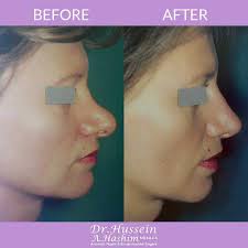 Septorhinoplasty: Correcting Nasal Septum, Nose Shape & Size