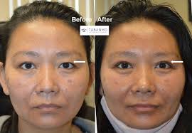 For these reasons, i find that indications for brow lift surgery are less. Asian Blepharoplasty And Eyelid Crease Surgery Photos Mehryar Ray Taban Md