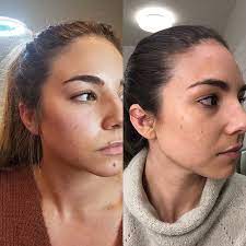 It's no longer thought of solely as an answer to wrinkles and crow's feet. My Experience Receiving Botox For Tmj Lauryncakes