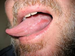 Image result for lichen planus on tongue)