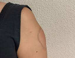 moderna nin asisi covid 19 kolu adi verilen bir yan etkiye yol acti saglik haberleri ntv