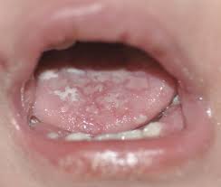 I know people want more information, because i posted a piece in 2011 on the difference between type 1 and. An Atlas Of Lingual Lesions Part 2 Consultant360