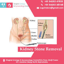 Kidney Stone Removal In 2020 Kidney Stones Kidney Surgery Kidney