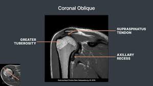 Image result for Shoulder MRI