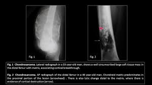 Image result for Chondrosarcoma