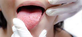 Image result for Candidiasis