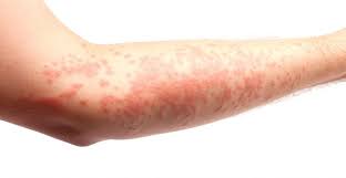 Brannon, md, is a family practice physician in mauldin, south carolina. Erythema Types Causes Symptoms And Treatments