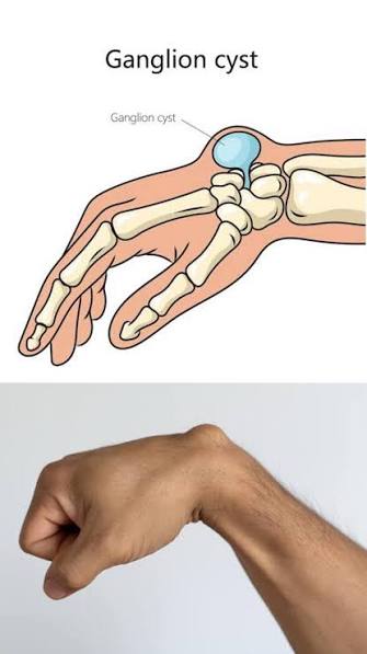 A ganglion cyst is a noncancerous, fluid-filled lump that commonly forms  near joints or tendons, especially in the wrist, hand, ankle, or foot., 🔍  Key Features:, &bull; Contents: Filled with a jelly-like ...