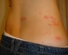 Se caracterizează prin durere și apariția unei benzi eruptive ce se întinde pe o singură parte a corpului. Tipuri De Ciuperci De Piele Cu Poze Dureri De