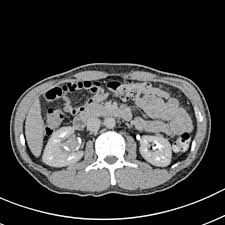 Which pelvis anatomical formation is to be punctured to confirm the diagnosis? Transitional Cell Carcinoma Of The Renal Pelvis Radiology Case Radiopaedia Org
