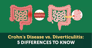 Image result for Diverticulitis