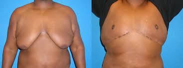 Maybe you would like to learn more about one of these? Gynecomastia Surgery Sacramento Granite Bay Dr Scott Green