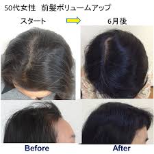女性の薄毛と女性発毛実績 感想 薄毛 薄毛 女性 髪の育毛