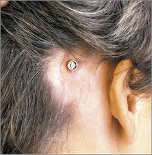 Baha is a technology that combines a sound processor with a small titanium fixture implanted behind the ear. Baha