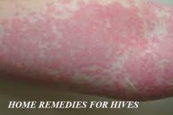 Rashes brought about by food allergies tend to cover larger portions of the body such as the back, face and arms. Home Remedies For Hives Getatoz