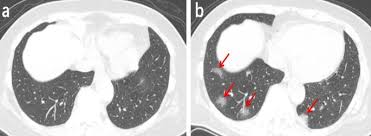 Ct Imaging Changes Of Corona Virus Disease 2019 Covid 19 A Multi Center Study In Southwest China Journal Of Translational Medicine Full Text