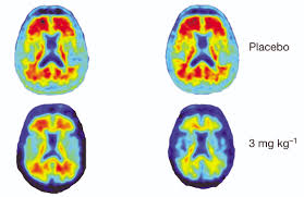 And by june 7, the u.s. New Alzheimer S Drug Clears Abnormal Protein Clogs In Small Promising Trial Pbs Newshour