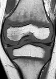 The trunk line has multiple fiber optic cables combined together to increase the capacity. Mr Imaging Of Pediatric Bone Marrow Radiographics