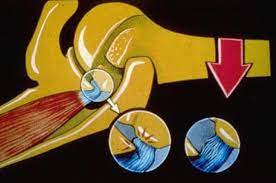 Shoulder Impingement 3 Keys To Assessment And Treatment Mike Reinold