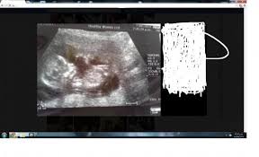 If it has implanted outside your uterus, it's called an ectopic pregnancy, which is a medical emergency. Wat Do The Numbers On Scan Photo Mean