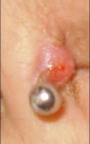 Infected Belly Button Piercing Signs Pictures How To Treat Fix Ring Bump How To Clean Heal Bell Infected Belly Button Belly Button Piercing Navel Piercing