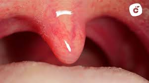 Image result for Uvulitis