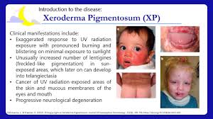 Xeroderma pigmentosum defines a class of autosomal recessive inherited diseases that are characterized clinically by sun sensitivity that results in. Xeroderma Pigmentosum Youtube