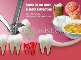 Foods To Eat After A Tooth Extraction Tooth Decay Food After Tooth Extraction Eating After Tooth Extraction Tooth Extraction Aftercare