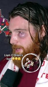 NHL Player's Unbelievable Black Eye Experience
