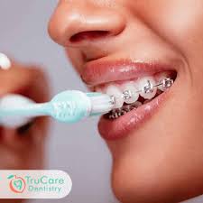 If you got your braces off and you do have stains on your teeth, some dental professionals recommend waiting 6 months before you whiten make sure you visit your dentist for a good cleaning right after you get your braces off. Can Teeth End Up With Stains During Braces Invisalign Treatment How To Avoid Staining Trucare Dentistry Roswell