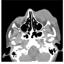 Image result for phlegmon on face)