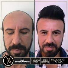 Million Hair Center Sac Ekim Merkezi