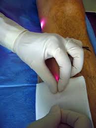 Chaque séance dure environ vingt minutes. Laser Radiofrequence Pour Traiter Les Varices Comment Ca Marche