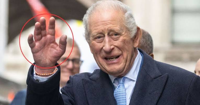 King Charles Fingers