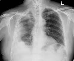 Chest Roentgenogram Plain Chest Film Showed Right Side Loculated Download Scientific Diagram