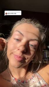 Replying to @aliyahmakel this is before and after of using the ordinary for  2 weeks. I have a couple blemishes above my eyebrows. I think its because  of ive been super stressed out and thats where i ...