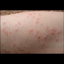 Spider Bites That Look Like Mosquito Bites Pin On Bites And Stings